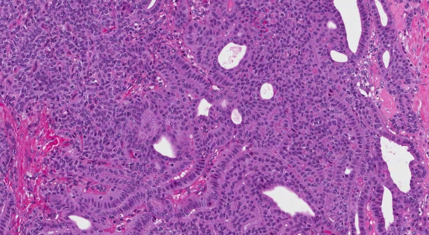 Cribriform morular thyroid carcinoma
