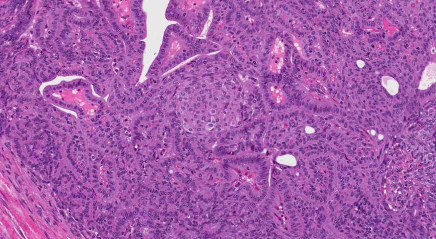 Cribriform morular thyroid carcinoma