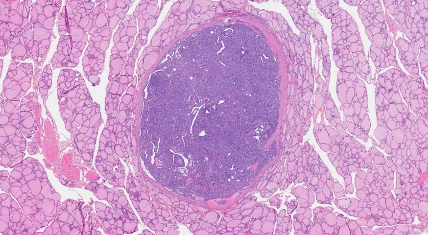 Cribriform morular thyroid carcinoma
