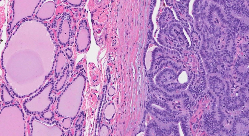 Cribriform morular thyroid carcinoma