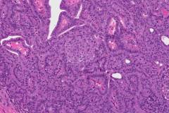 Cribriform morular thyroid carcinoma