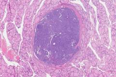 Cribriform morular thyroid carcinoma