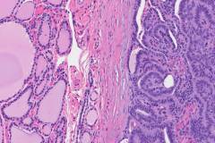 Cribriform morular thyroid carcinoma