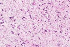 Dedifferentiated liposarcoma