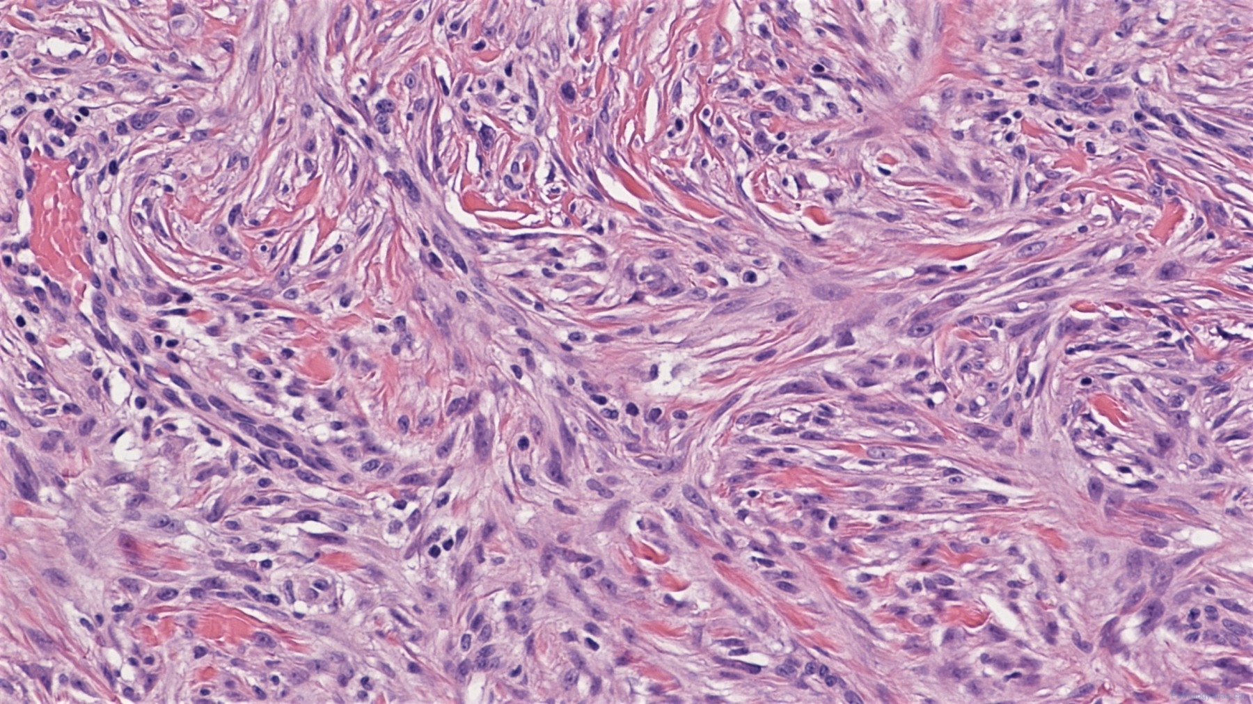 Deep Fibrous Histiocytoma Atlas Of Pathology