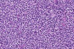 Diffuse large B cell lymphoma