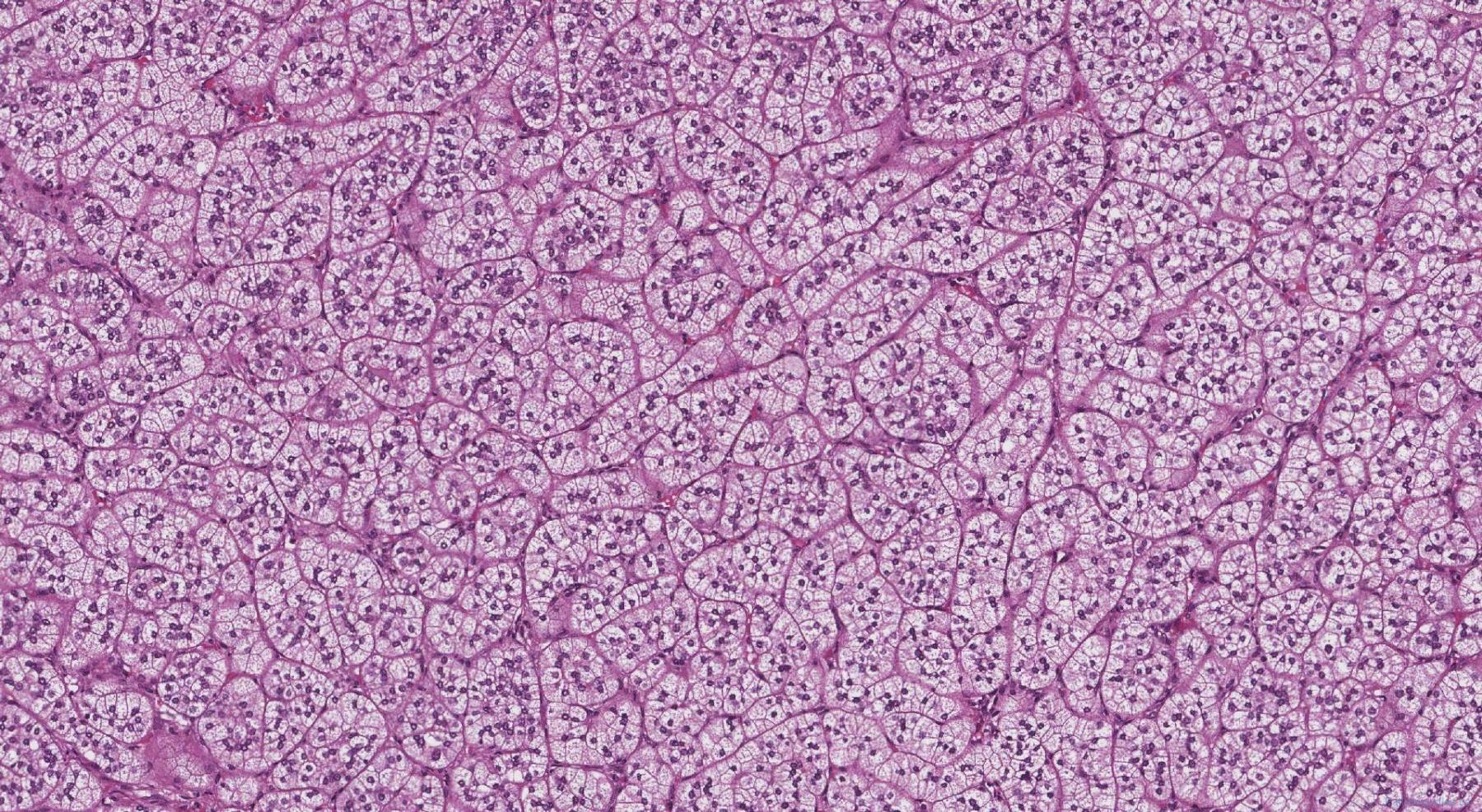 diffuse nodular hyperplasia Archives | Ottawa Atlas of Pathology