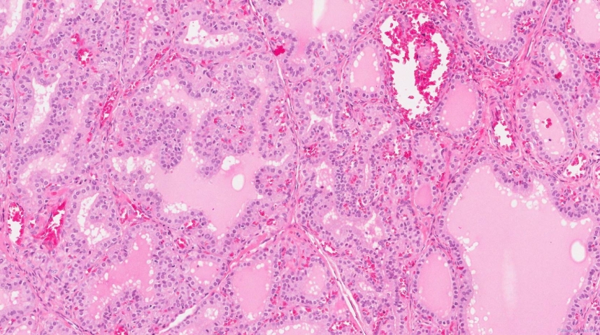Diffuse papillary hyperplasia of the thyroid gland secondary to Grave's disease