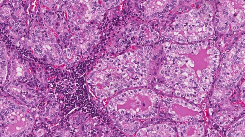 Diffuse papillary hyperplasia of the thyroid gland secondary to Grave's disease