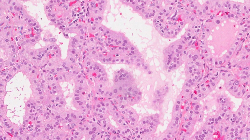 Diffuse papillary hyperplasia of the thyroid gland secondary to Grave's disease