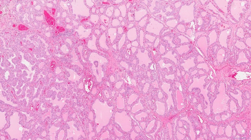 Diffuse papillary hyperplasia of the thyroid gland secondary to Grave's disease