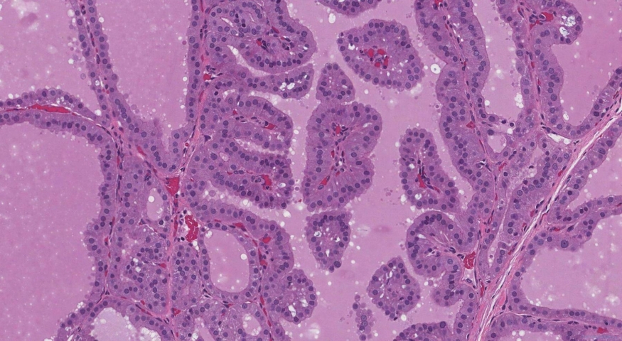 Diffuse papillary hyperplasia of the thyroid gland in a patient with Graves disease