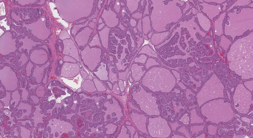 Diffuse papillary hyperplasia of the thyroid gland in a patient with Graves disease