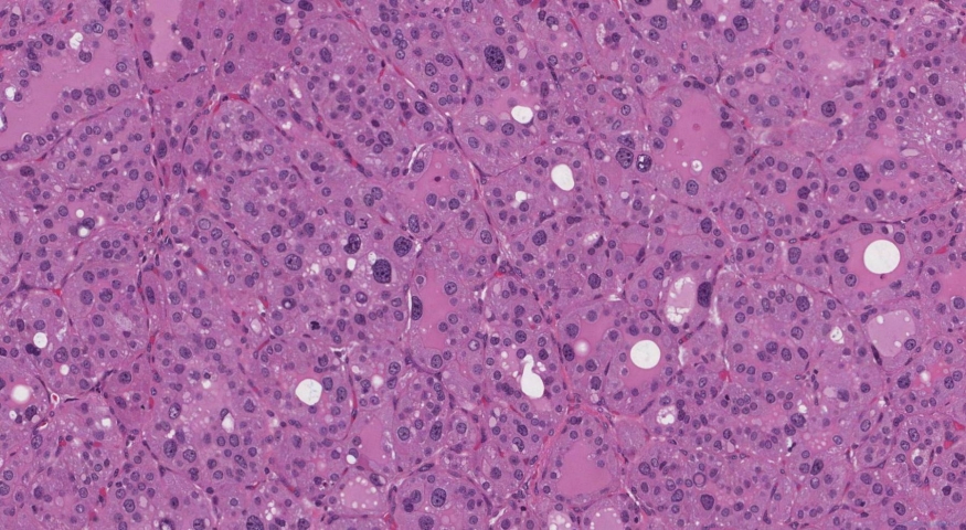 Endocrine atypia of the thyroid gland in a patient with a history of Grave's disease