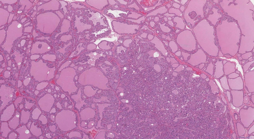 Endocrine atypia of the thyroid gland in a patient with a history of Grave's disease
