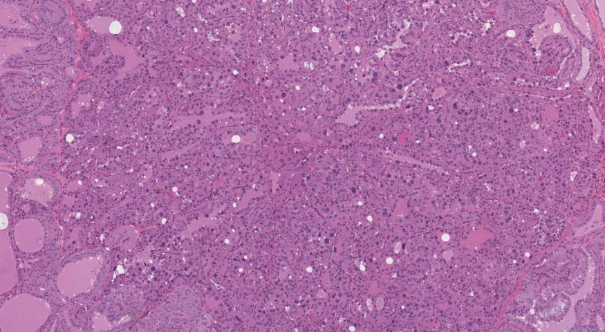 Endocrine atypia of the thyroid gland in a patient with a history of Grave's disease