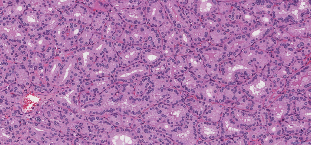 Diffuse papillary hyperplasia of the thyroid gland secondary to Grave's disease