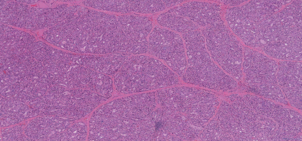 Diffuse papillary hyperplasia of the thyroid gland secondary to Grave's disease