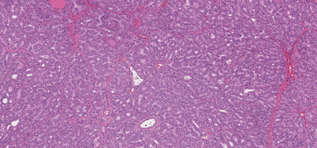 Diffuse papillary hyperplasia of the thyroid gland secondary to Grave's disease