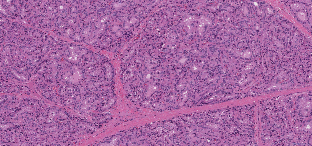 Diffuse papillary hyperplasia of the thyroid gland secondary to Grave's disease