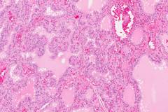 Diffuse papillary hyperplasia of the thyroid gland secondary to Grave's disease