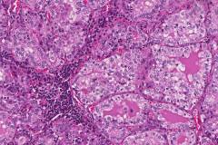 Diffuse papillary hyperplasia of the thyroid gland secondary to Grave's disease