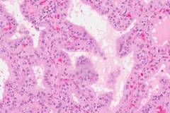 Diffuse papillary hyperplasia of the thyroid gland secondary to Grave's disease