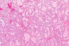 Diffuse papillary hyperplasia of the thyroid gland secondary to Grave's disease