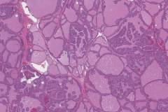 Diffuse papillary hyperplasia of the thyroid gland in a patient with Graves disease