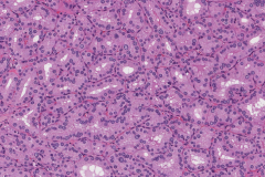 Diffuse papillary hyperplasia of the thyroid gland secondary to Grave's disease