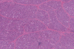 Diffuse papillary hyperplasia of the thyroid gland secondary to Grave's disease