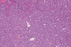 Diffuse papillary hyperplasia of the thyroid gland secondary to Grave's disease