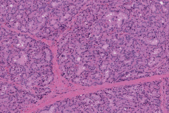 Diffuse papillary hyperplasia of the thyroid gland secondary to Grave's disease