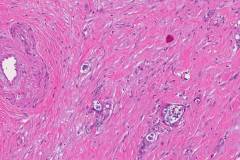 Ductal adenocarcinoma of the pancreas
