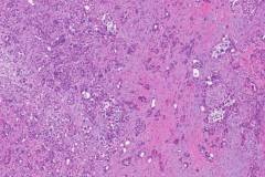 Ductal adenocarcinoma of the pancreas