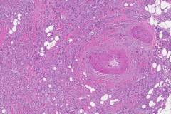 Ductal adenocarcinoma of the pancreas