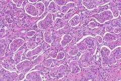 Ductal adenocarcinoma of the pancreas