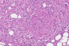Ductal adenocarcinoma of the pancreas