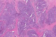 Ductal adenocarcinoma of the prostate gland