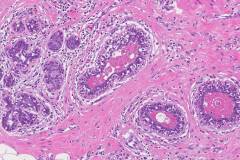 Ductal carcinoma in situ of the breast