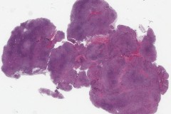 EBV-positive diffuse large B-cell lymphoma
