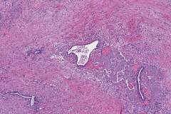 Endometriosis involving the diaphragm