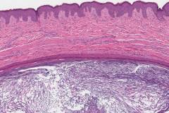 Epidermoid cyst