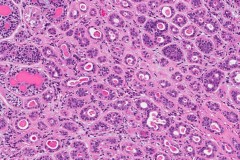 Epithelial-myoepithelial carcinoma