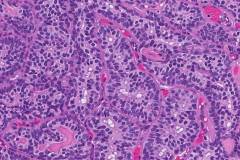 Epithelial-myoepithelial carcinoma