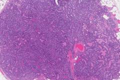 Epithelial-myoepithelial carcinoma