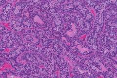 Epithelial-myoepithelial carcinoma