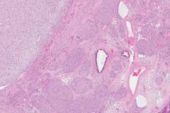 Epithelial-myoepithelial carcinoma