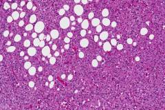 Epithelioid angiomyolipoma arising in the retroperitoneum