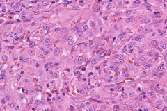 Epithelioid angiosarcoma